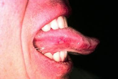 hand foot and mouth disease in mouth