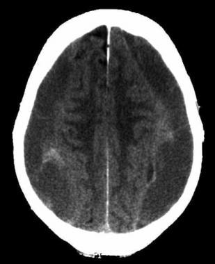 Bilateral chronic subdural hematomas shown on CT s