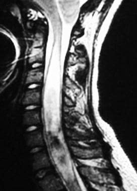 MRI of a cervical syrinx in the sagittal plane. 