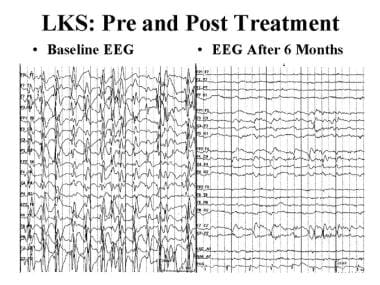 Epileptic and epileptiform encephalopathies. EEG i