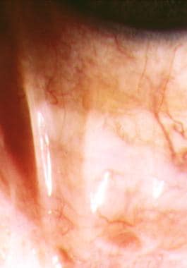 Atopic keratoconjunctivitis. This image depicts a 