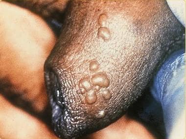 Genital herpes (male); vesicular lesions of HSV af