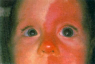 Female infant with Sturge-Weber syndrome. Facial p