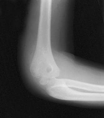 lateral condyle fracture milch