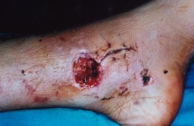 Wound on medial aspect of ankle after 8 days. 