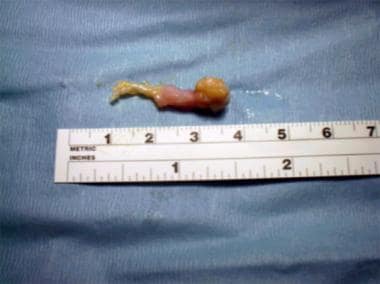 Surgery for Morton neuroma. Neuroma and adherent f
