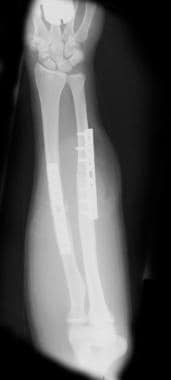 Anteroposterior radiograph of completed fixation o