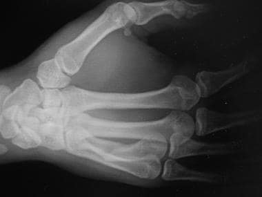 Oblique radiograph of the hand shows dorsal angula