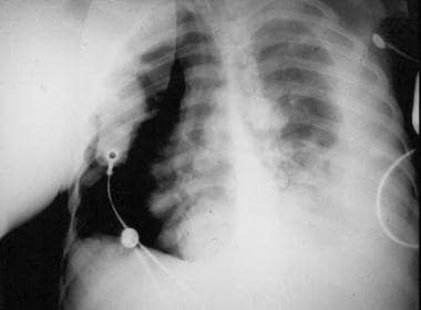 Chest radiograph of patient with osteosarcoma who 