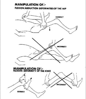 Manipulation of deformities of hip. 