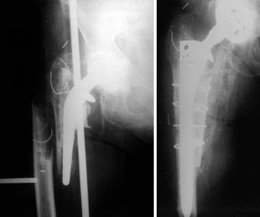 Fracture around loose prosthesis treated with repl