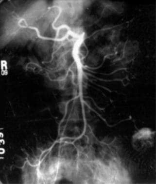 Benign neoplasm of the small intestine. Arteriogra