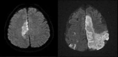 Vascular distributions: Anterior cerebral artery (