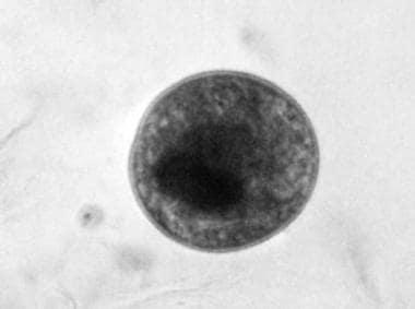 Cyst of Balantidium coli in feces. This photograph