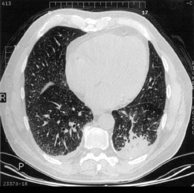 Chest computed tomography (CT) scan showing pulmon