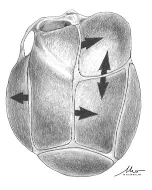 Unilateral coronal craniosynostosis (anterior plag