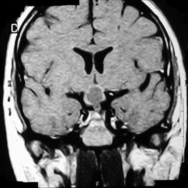 Coronal MRI shows a craniopharyngioma in the supra