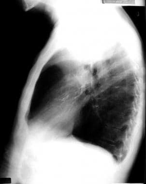 Emphysema. A lateral chest radiograph of Swyer-Jam