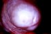 Balanitis