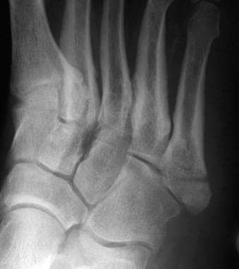 Fractures, foot. Proximal fifth metatarsal avulsio