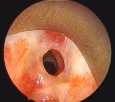 Preoperative view of subglottic stenosis via an en