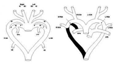 Double Aortic Arch. Schematic diagram (left) of th