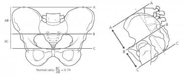 Calculation of sacral ratio. 