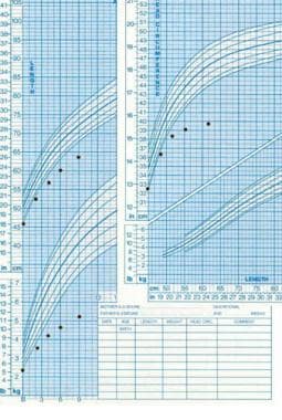 Russell Silver Syndrome Growth Chart