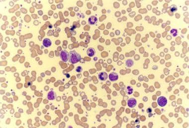 Photomicrograph of a peripheral smear of a patient