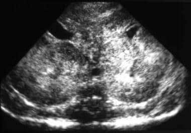 Sonogram shows enlargement of both kidneys, diffus