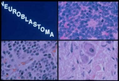 Histologic subtypes of neuroblastoma. Top right pa