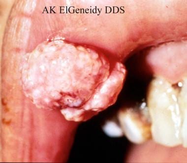 Human papillomavirus (HPV). Condyloma acuminatum o