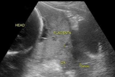  Another ultrasound image clearly depicting comple