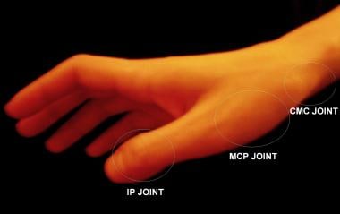 Anatomic locations of joints of thumb. 