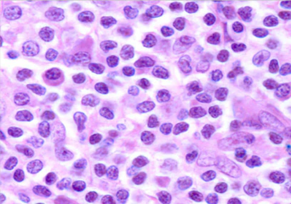 Marginal Zone Lymphoma