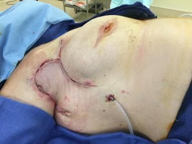 As this intraoperative photo illustrates, even lar