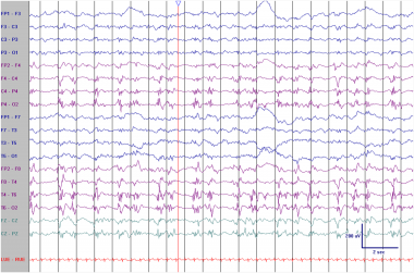 PLEDs in an elderly patient with an acute right mi