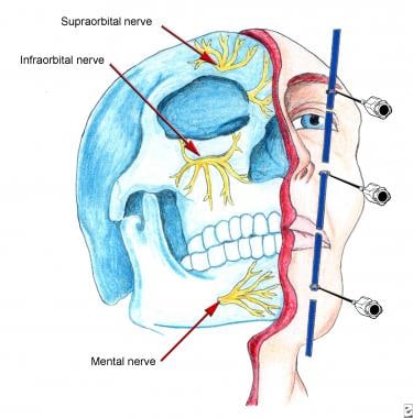 Distal trigeminal block technique. See text for de