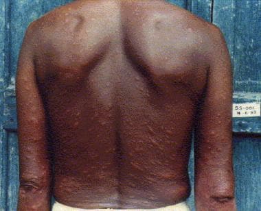 Patient with lepromatous leprosy showing multiple 