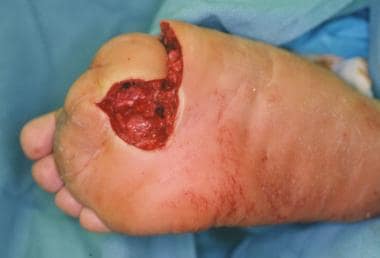Reconstructive surgery of diabetic foot after infe