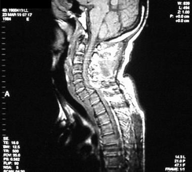 Sagittal MRI of facet dislocation of C7 on T1. 