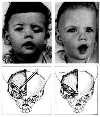 Congenital, synostoses. Plagiocephaly due to right