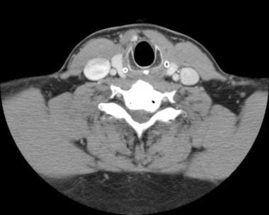 Enhanced CT of the neck in the same patient as in 