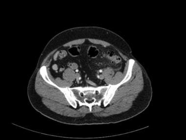 Diverticulitis without abscess. 