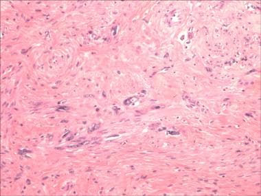 Leiomyoma with atypia (formerly called symplastic 