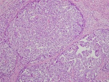 Pathology of embryonal carcinoma. Embryonal carcin