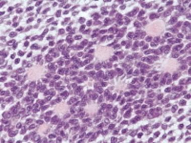 Granulosa cell tumor, microfollicular pattern. Cal