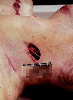 Forensic Autopsy of Sharp Force Injuries. A lacera