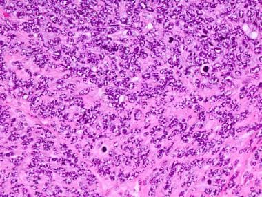 Myoepithelial Carcinoma. Spindle cell myoepithelia