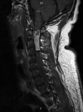 T1-weighted post contrast sagittal magnetic resona